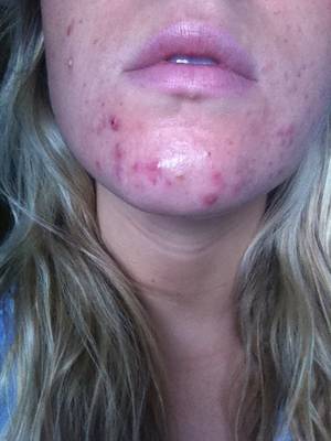 Acne Pussy - 2010 - taking antibiotics