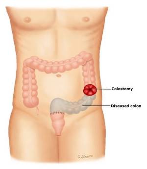 anal sex colon - For those of us unfamiliar with diverticular (say: die-ver-tick-yoo-ler)  disease, it affects the large intestine, or colon.