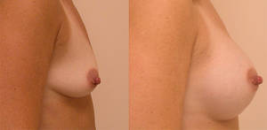 before after preggo nipples - Before and after breast augmentation in patient who plans to breast feed in  the future