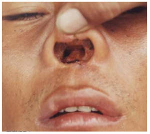 Cocaine Mouth - Side effect of frequent cocaine drug use. With a perforated septum, think  of how