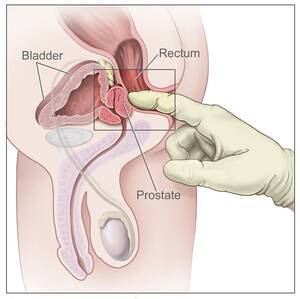 cancer from anal sex - Anal Cancer | Vanderbilt-Ingram Cancer Center