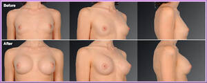 ladyboy fat transfer augmentation - Second Type Woman - Breast Augmentation