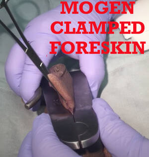 Mogen - ADULT CIRCUMCISION WITH A MOGEN CLAMP - ThisVid.com