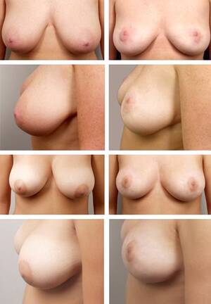 before and after lactating tits - Before And After Lactating Tits - Bobs and Vagene