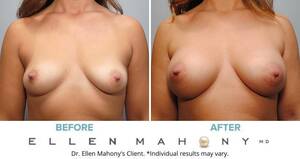 natural 38d saggy boobs - Breast Procedures Archives - DrEllenMahony.com