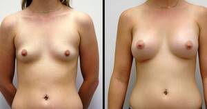 before and after lactating tits - Before And After Lactating Tits - Bobs and Vagene