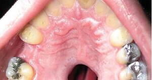 Cocaine Mouth - Cocaine-Induced Palatal Perforation. : r/WTF