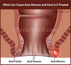 excessive anal sex - Conditions Caused By Excessive Anal Sex