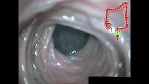 Colon Enema Porn - Anal Colon Condition