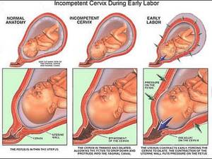 cervix pregnant wife nude - Incompetent Cervix - Losing a pregnancy before 24 weeks