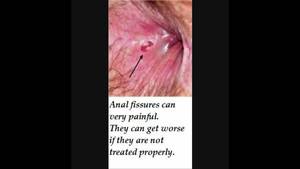 Immediate Relief For Anal Fissures - 