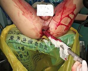 Anal Injury Porn - Perianal injury with rebar : r/medizzy