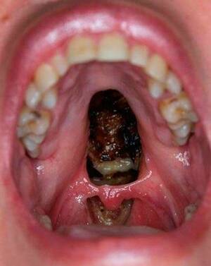 Cocaine Mouth Porn - This gross viral picture shows EXACTLY what cocaine does to your body