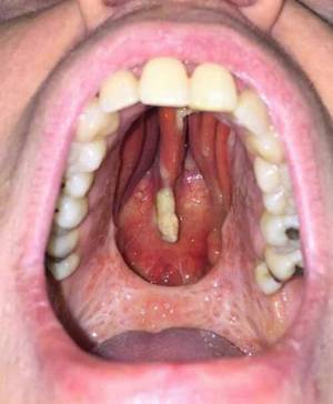 Cocaine Mouth - malformalady: Hard and soft palate necrosis in a case a chronic cocaine  abuse