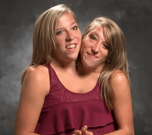 Conjoined Twin Porn Fuck - Conjoined twins Abby and Brittany Hensel (see Comments for more info) :  r/BeAmazed