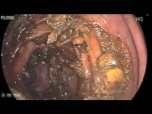 Colonoscopy Porn - Colonoscopy porn videos - BEST XXX TUBE