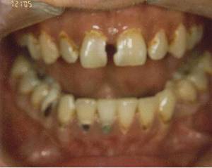 Meth Mouth Porn - I think this is so gross and ugly..i would be so embarrassed I. Meth MouthPharmacy  ...