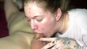 Acne Porn Fetish - Free Acne Porn Videos - Free HD Porn - GoFucker.Net