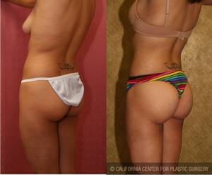 ladyboy fat transfer augmentation - Mary kate twins nude