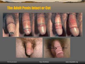 Circumcised Vs Uncircumcised Porn - MGM removes 1/3 to 1/2 of all skin on the penis.NSFW