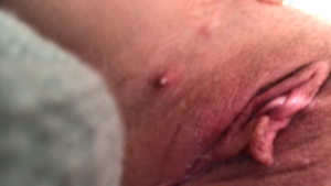 Acne Pussy - NSFW My glorious pussy pop that had been brewing for 3 days : r/popping