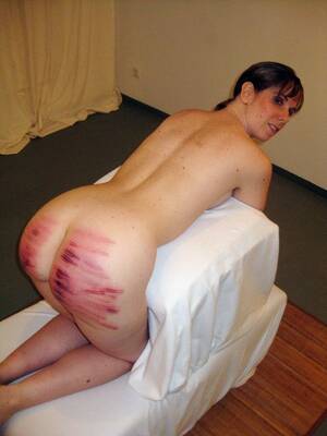 caning welts - Welts From Caning