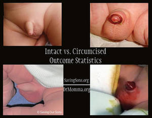 Circumcised Vs Uncircumcised Porn - Above: Newborn boys in their normal intact state (left) and those who have  had their prepuce amputated via circumcision (right). Top left = Plastibell.