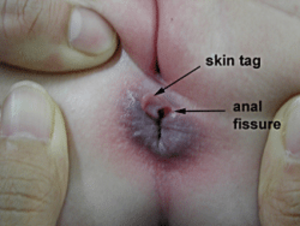 anal skin tag porn - Anal skin growth . Porn Images.