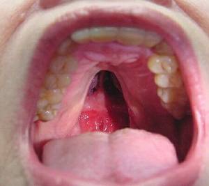 Cocaine Mouth Porn - 10 best Cocaine abuse images on Pinterest | Alcohol drug, Articulation  therapy and Brain health