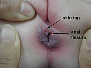 anal lump - Black bump on anus - Photos and other amusements. Comments: 4