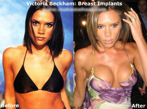 fake natural boobs - fake boobs are ugly - they look like grotesque \