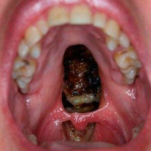 Cocaine Mouth - This gross viral picture shows EXACTLY what cocaine does to your body