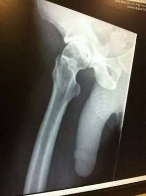 Broken Bone Porn - X-ray porn.