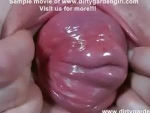 interracial cervix - Cervix prolapse extreme pussy dilation dirtygardengirl