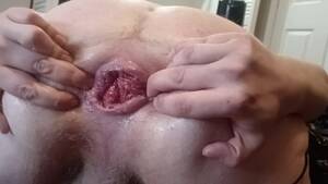 anal skin tag porn - Anal Skin Tag Porn | Sex Pictures Pass