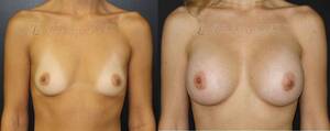 before and after lactating tits - Before And After Lactating Tits - Bobs and Vagene