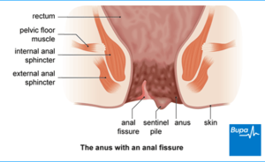 Forced Painful Anal Sex - Anal Fissure | Bupa UK