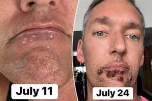 Disease Porn - Monkeypox patient shares timeline selfies showing how lesions grew over his  face