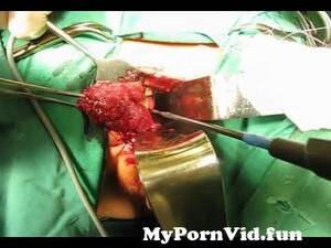 anal polyp - Transanal Excision of Giant Rectal Polyp from trans anal con pollon Watch  Video - MyPornVid.fun