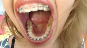 Braces Fetish Porn Tumblr - Braces Girl Webcam Mouth Tour - ThisVid.com