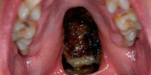 Cocaine Mouth - This gross viral picture shows EXACTLY what cocaine does to your body