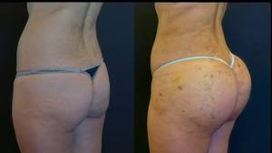 ladyboy fat transfer augmentation - Susie Wilden Laura Bailey Scoreland