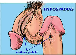 hypospadias massive cock - 