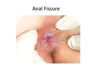 Immediate Relief For Anal Fissures - ... Teen porn sex videos watch ...