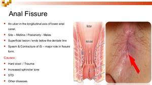 Immediate Relief For Anal Fissures - 