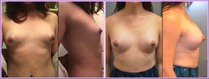 ladyboy fat transfer augmentation - Second Type Woman - Breast Augmentation