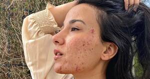 Acne Porn Fetish - Acne Porn Fetish | Sex Pictures Pass