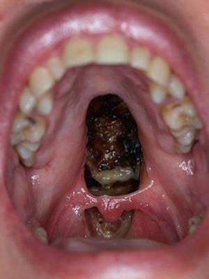 Cocaine Mouth - News, Dentist Shares Picture Of Cocaine User's Mouth