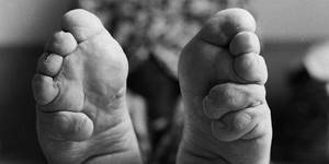 foot binding - These graphic images show the last surviving women in China with bound feet