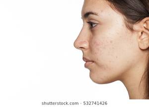 free junior tits - profile of young girl with acne on white background